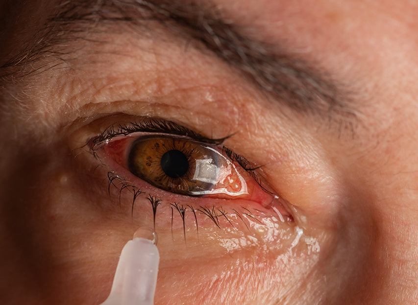 person with severe dry eye